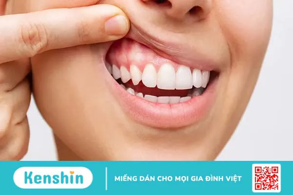 Cấu tạo của nướu răng và các bệnh lý thường gặp ở nướu răng