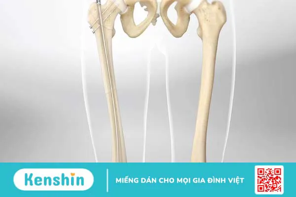 Cấu trúc của xương đùi trong cơ thể con người