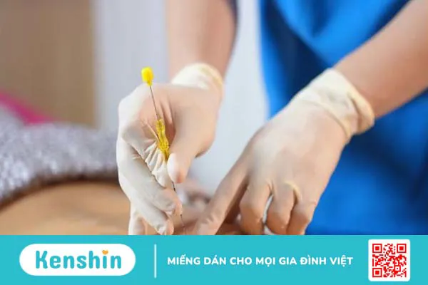 Cấy chỉ là gì? Cấy chỉ bao lâu thì có tác dụng?