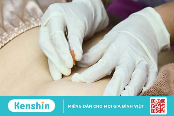 Cấy chỉ: Thông tin từ A đến Z về phương pháp này! 1