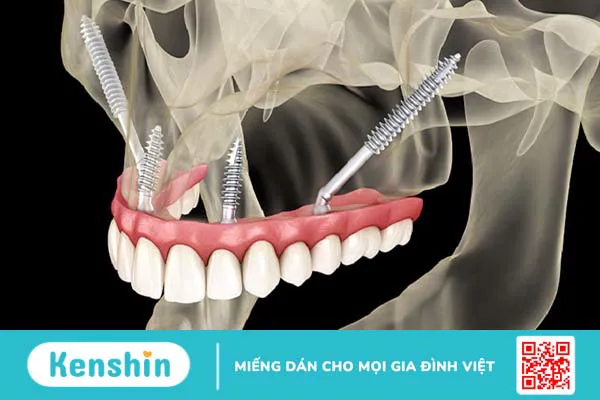 Cấy ghép Zygoma Implant có an toàn không?