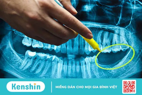 Cấy ghép Zygoma Implant có an toàn không? 3