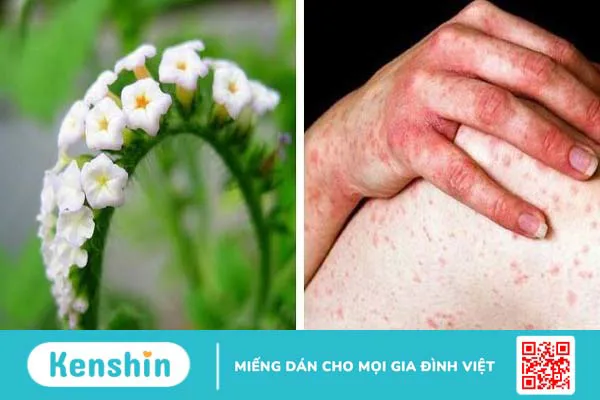 Cây vòi voi chữa vảy nến có hiệu quả không?