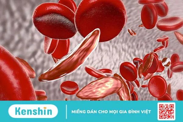 Chẩn đoán và điều trị Thalassemia