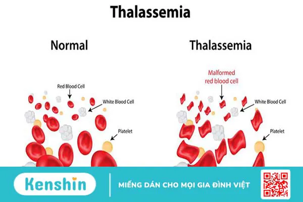 Chẩn đoán và điều trị Thalassemia