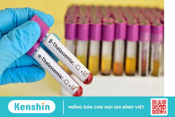 Chẩn đoán và điều trị Thalassemia