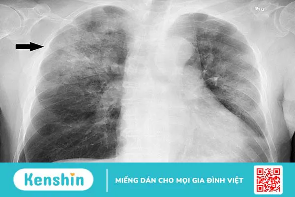 Chẩn đoán viêm phổi bằng cách nào?