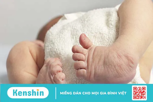 Chân khoèo bẩm sinh: Nguyên nhân, triệu chứng và cách điều trị