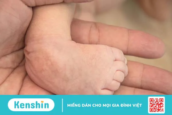 Chân khoèo bẩm sinh: Nguyên nhân, triệu chứng và cách điều trị