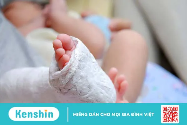 Chân khoèo bẩm sinh: Nguyên nhân, triệu chứng và cách điều trị