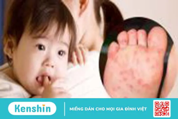 Chân tay miệng có dùng kháng sinh không? Các cách phòng ngừa bệnh