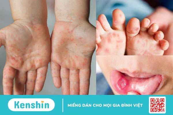 Chân tay miệng có dùng kháng sinh không? Các cách phòng ngừa bệnh