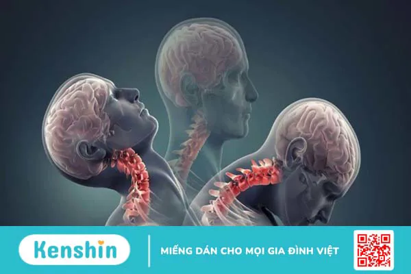 Chấn thương cổ thường gặp chẳng thể ngờ -1