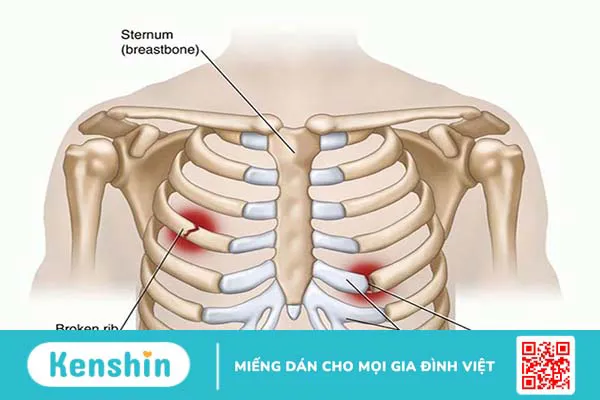 Chấn thương ngực kín là gì? Một số bệnh cảnh trong chấn thương ngực kín