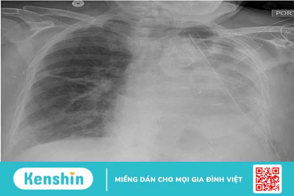 Chấn thương ngực kín là gì? Một số bệnh cảnh trong chấn thương ngực kín