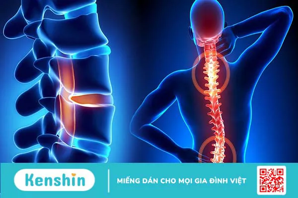 Chấn thương tủy sống liệt 2 chi dưới do đâu?