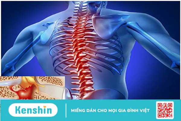 Chấn thương tủy sống liệt 2 chi dưới do đâu?