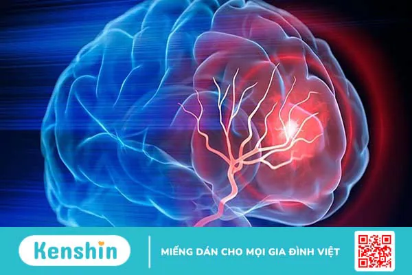 Chảy máu não nguy hiểm thế nào?