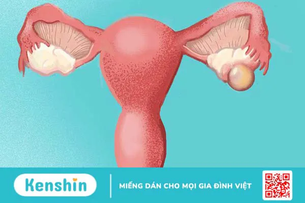 Chảy máu trong ổ bụng không do chấn thương: Chẩn đoán, điều trị 2