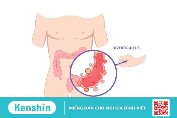 Chảy máu túi thừa đại tràng: Triệu chứng và cách điều trị