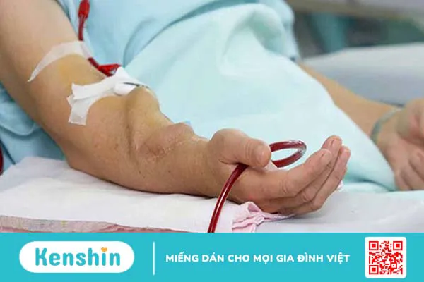 Chỉ định đóng lỗ rò động – tĩnh mạch cho người bệnh khi nào?