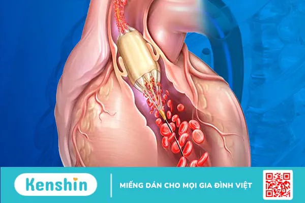 Chỉ định và chống chỉ định của phương pháp nong van động mạch phổi