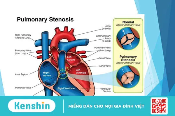 Chỉ định và chống chỉ định của phương pháp nong van động mạch phổi