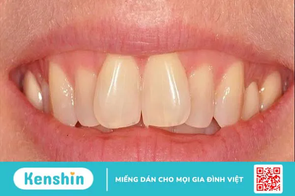 Chỉ niềng 2 răng cửa được không? Các phương pháp niềng răng hiệu quả nhất