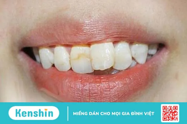 Chỉ có thể niềng 2 răng cửa được không? Các phương pháp niềng răng hiệu quả nhất 1