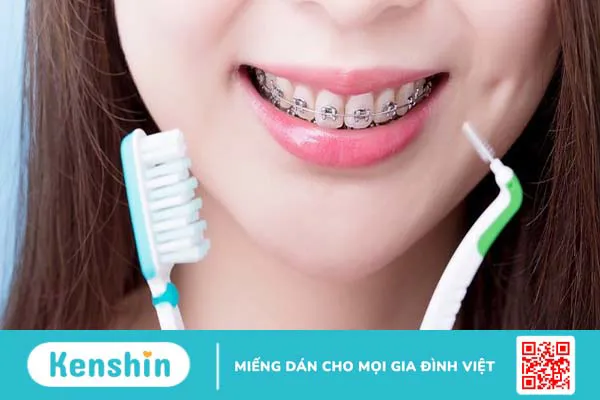 Chỉ có thể niềng 2 răng cửa được không? Các phương pháp niềng răng hiệu quả nhất 4