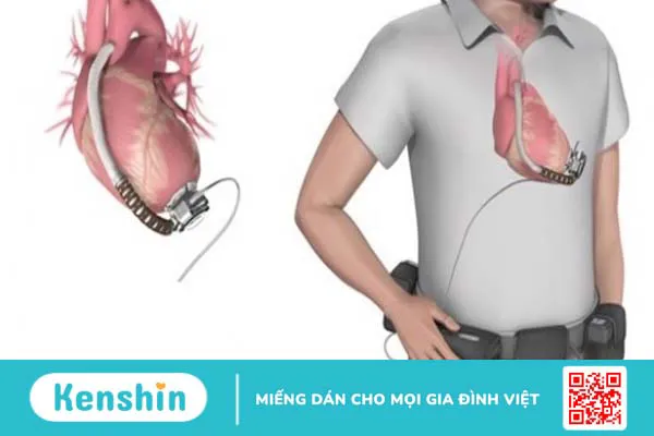 Chi phí cấy thiết bị hỗ trợ thất trái cho người suy tim là bao nhiêu