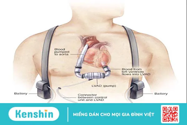 Chi phí cấy thiết bị hỗ trợ thất trái cho người suy tim là bao nhiêu 2