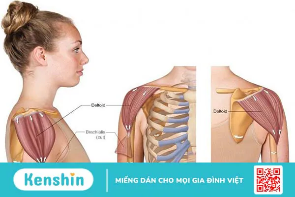 Chi phí mổ teo cơ delta là bao nhiêu? Cập nhật chi tiết nhất