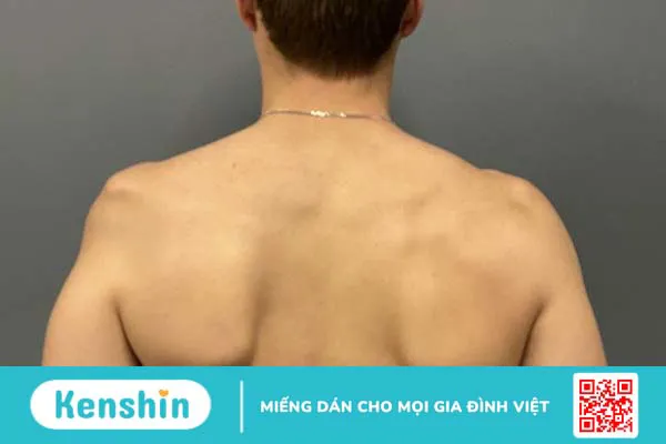 Chi phí mổ teo cơ delta là bao nhiêu? Cập nhật chi tiết nhất