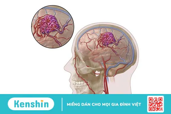 Chi phí phẫu thuật dị dạng mạch máu não khoảng bao nhiêu?