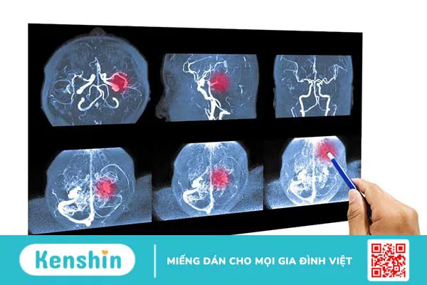 Chi phí phẫu thuật dị dạng mạch máu não khoảng bao nhiêu?