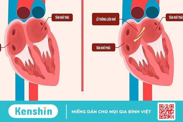 Chi phí phẫu thuật tim thông liên nhĩ là bao nhiêu?