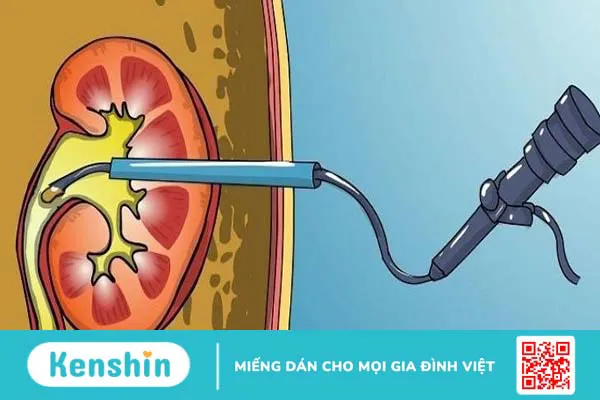 Chi phí tán sỏi thận qua da là bao nhiêu?