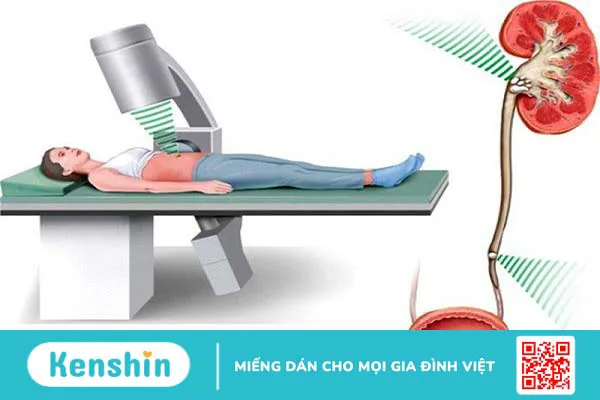 Chi phí tán sỏi thận qua da là bao nhiêu?