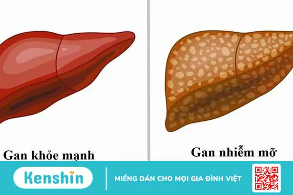 Chỉ số de ritis là gì? Ý nghĩa lâm sàng của chỉ số de ritis 4