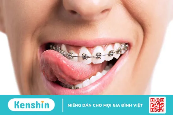 Chỉnh nha là gì? Các phương pháp chỉnh nha phổ biến hiện nay