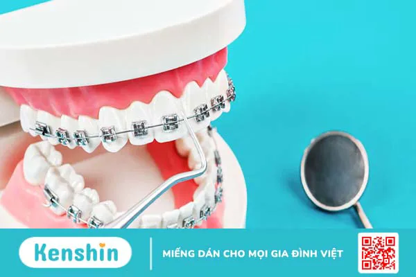 Chỉnh nha là gì? Các phương pháp chỉnh nha phổ biến hiện nay