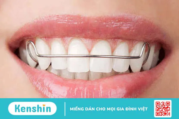 Chỉnh nha là gì? Các phương pháp chỉnh nha phổ biến hiện nay