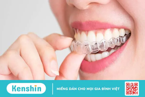 Chỉnh nha là gì? Các phương pháp chỉnh nha phổ biến hiện nay