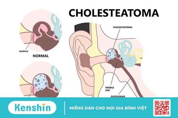 Cholesteatoma bẩm sinh là bệnh gì? Nguyên nhân, triệu chứng và cách điều trị