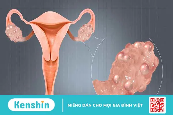 Chu kỳ kinh nguyệt thưa có con được không? Cần làm gì khi bị kinh nguyệt thưa?  2