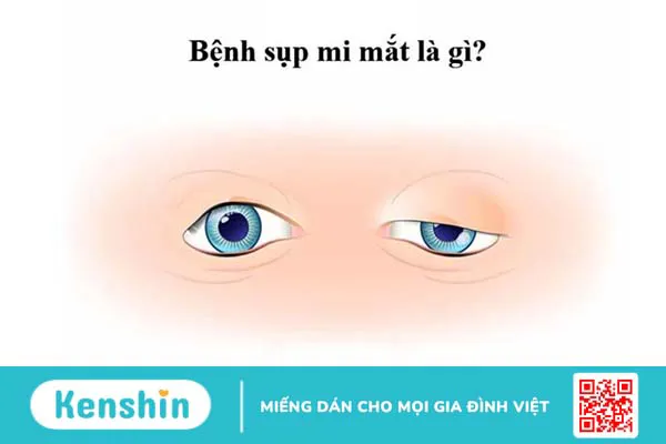 Chữa sụp mí bẩm sinh tại nhà có hiệu quả không?