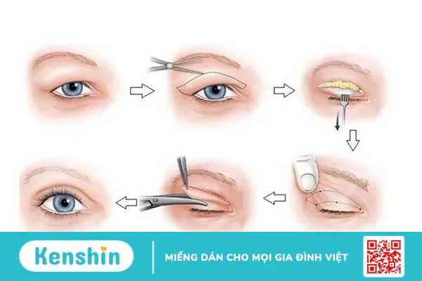 Chữa sụp mí bẩm sinh tại nhà có hiệu quả không?