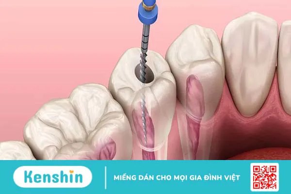 Chữa tủy răng có đau không và ai nên chữa tủy răng?