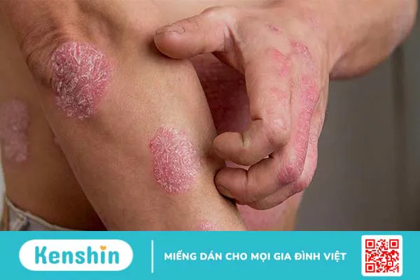 Chữa vảy nến bằng nhựa đu đủ có hiệu quả không?